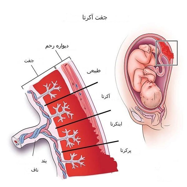جفت اکرتا یعنی جفت چسبیده