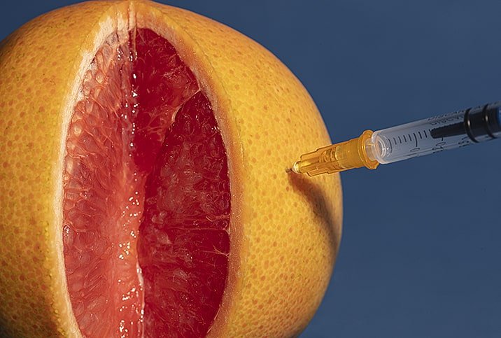 تزریق ژل یا چربی به لابیا ماژور