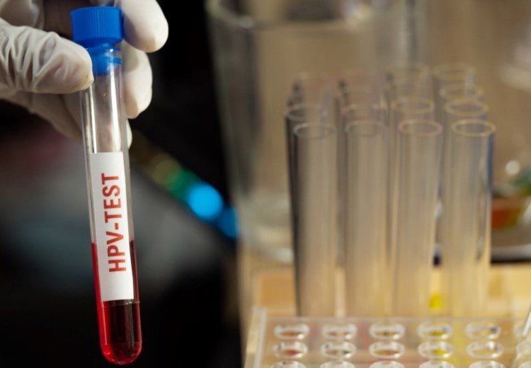 تست اچ پی وی