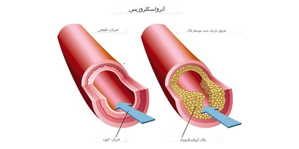 آترواسکلروزیس