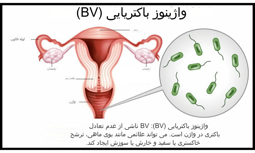 واژینوز باکتریال 1