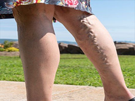 آیا می توانم از واریس جلوگیری کنم