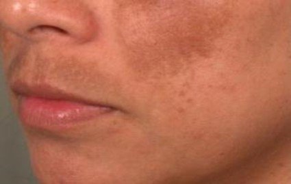 چرا پچ و لکه های تیره در دوران بارداری روی پوست 