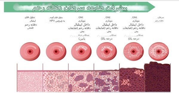 پیشرفت کنسر سرویکس