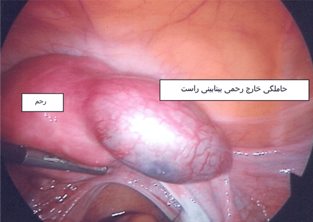 جراحی لاپاراسکوپی برای حاملگی خارج از رحم 
