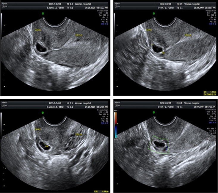 سونوگرافی بارداری خارج از رحم