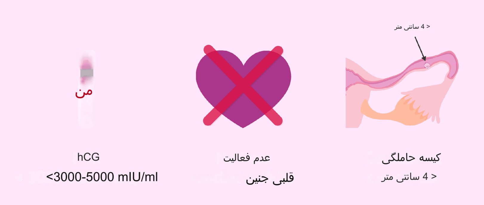 متوترکسات برای حاملگی خارج از رحم