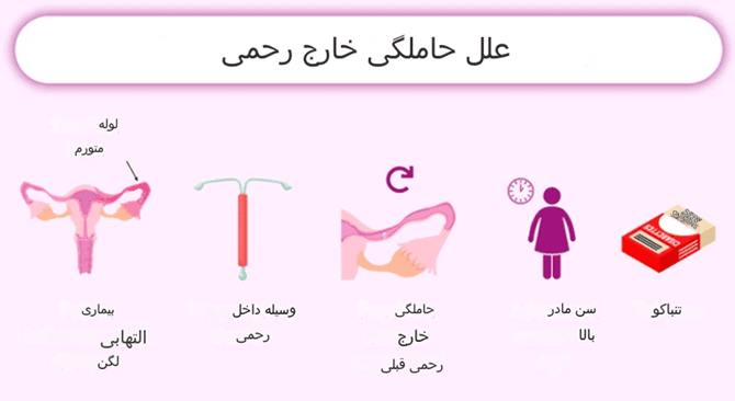 دلایل حاملگی خارج رحمی 