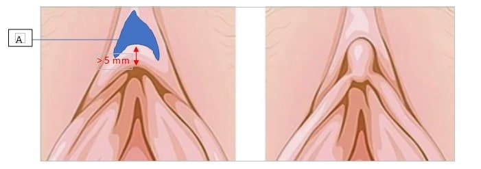 جراحی هودکتومی