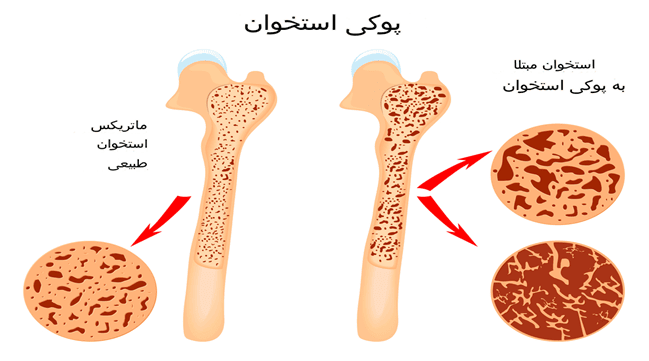 پوکی استخوان در یائسگی
