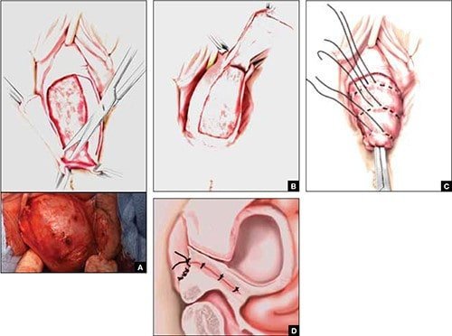 جراحی انسدادی