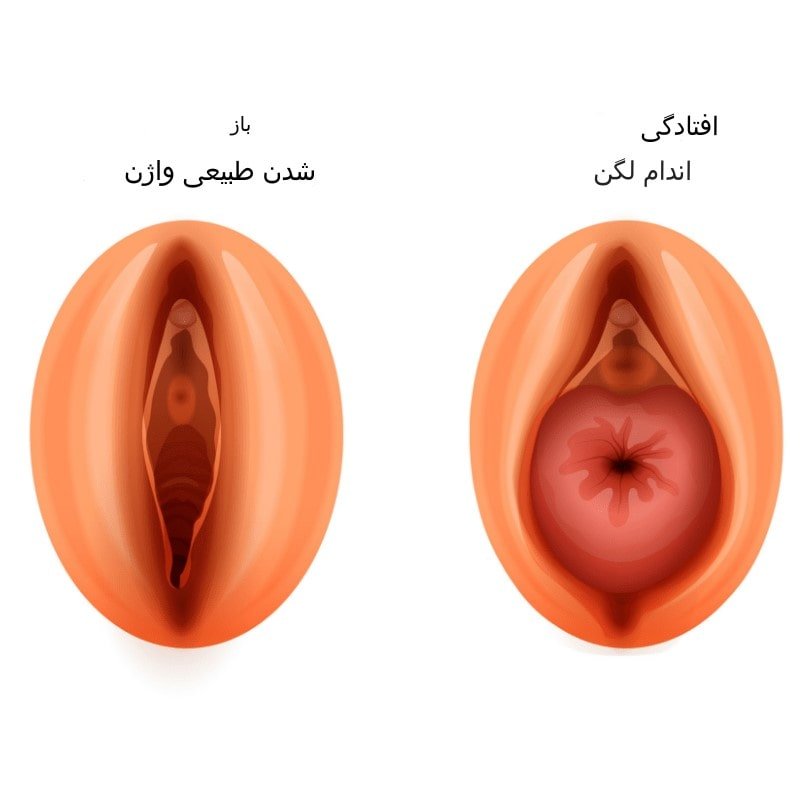 شکل واژن در افتادگی اندامها 
