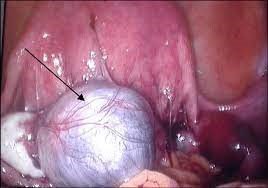 جراحی به روش لاپاراسکوپی یا لاپاراتومی به برداشت بافت آندومتریوزیس 