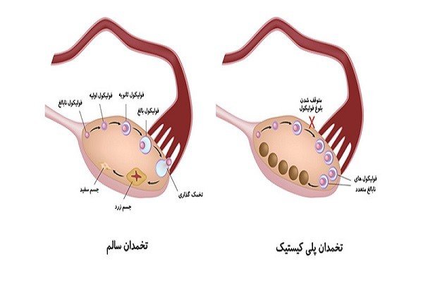 سندرم تخمدان پلی کیستیک (PCOS)  یا تنبلی تخمدان