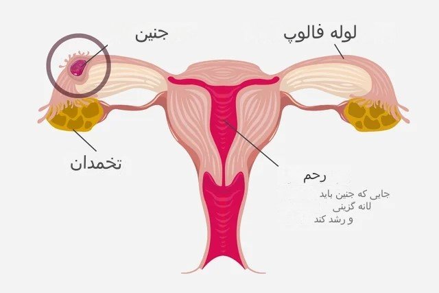 بارداری خارج از رحم 