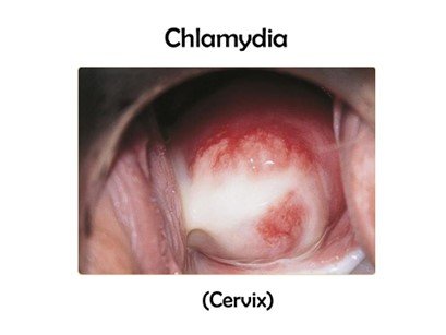 علائم کلامیدیا چیست