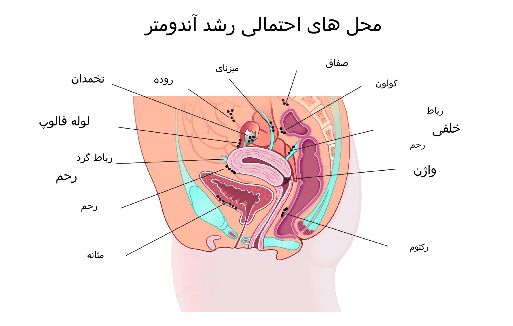 محل های شایع اندومتریوز