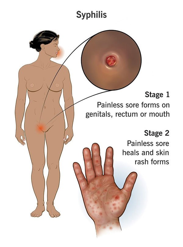 مراحل بیماری سیفلیس