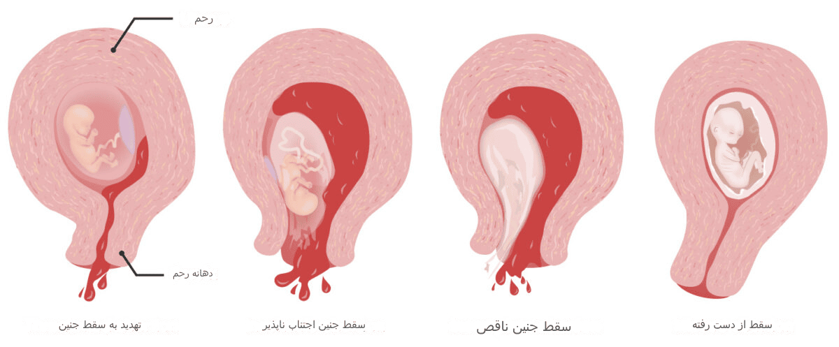 انواع سقط جنین