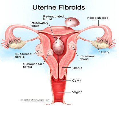 فیبروم رحم چیست؟