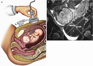 فیبروم در بارداری