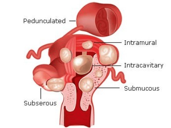 خطر فیبروم  رحمی