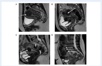 روش های تشخیص فیبروم رحم