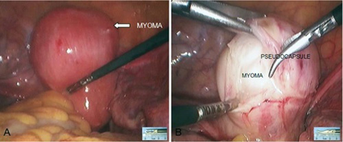 میومکتومی لاپاراسکوپی  برای فیبروم رحم