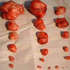 درمان جراحی فیبروم رحم