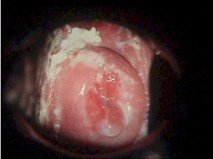 علائم عفونت قارچی  در واژن