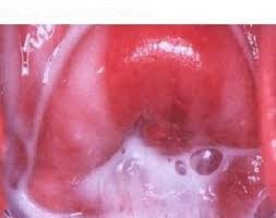 واژینوز باکتریال