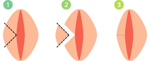 تکنیک وج در لبیاپلاستی